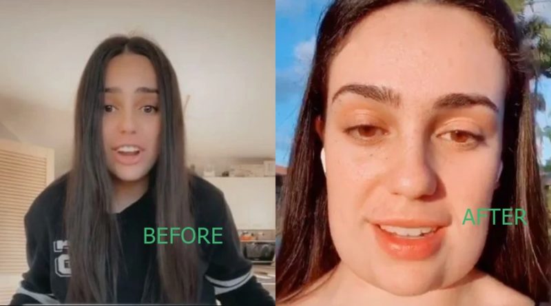 19-year-old lady ends up with square head after botched facial surgery