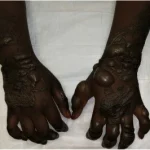 Aproko Doctor warns fake henna can cause permanent skin damage