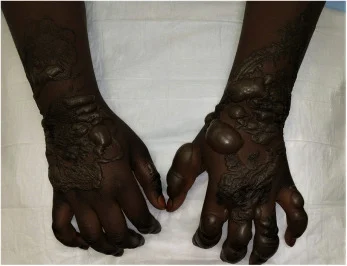 Aproko Doctor warns fake henna can cause permanent skin damage